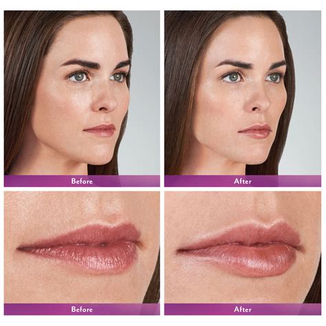 what happens to your lips after fillers