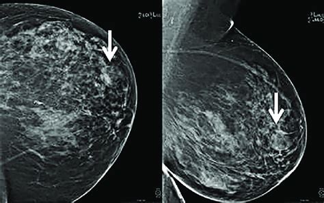 what happens when a mammogram is abnormal