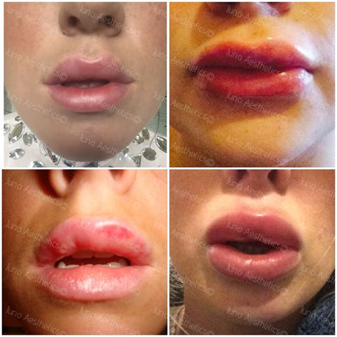 what helps lip swelling after fillers removal pictures