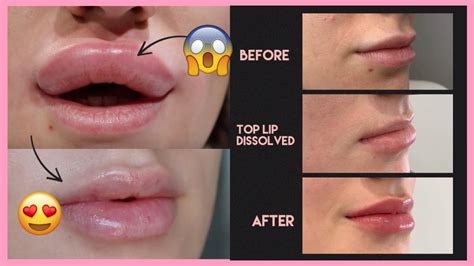 what helps lip swelling after fillers removal surgery