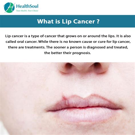 what is lip iceberg cancer treatment