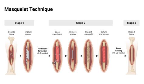 What Is Masquelet Technique