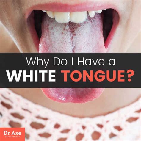 what it means when tongue is white