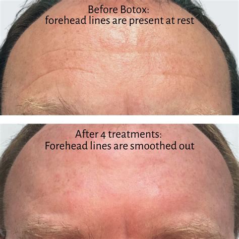 what to do after botox in forehead