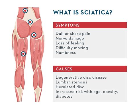 what to do for sciatica in leg