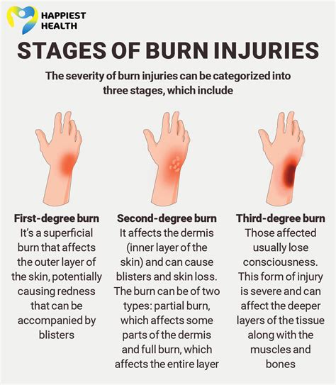 what to do in case of burn