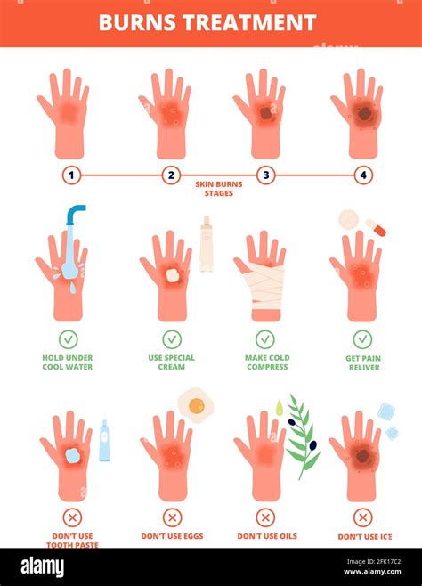 what to do when finger is burned