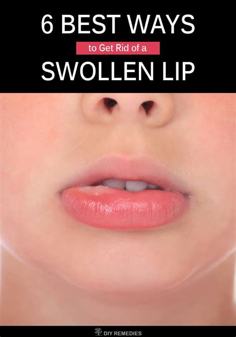 what will make a swollen lip go download