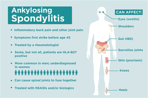 Full Download What Is Ankylosing Spondylitis 