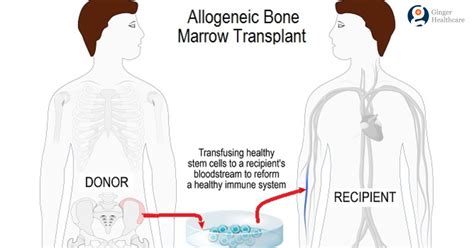 when is a bone marrow transplant needed