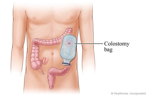 when is a colostomy bag necessary