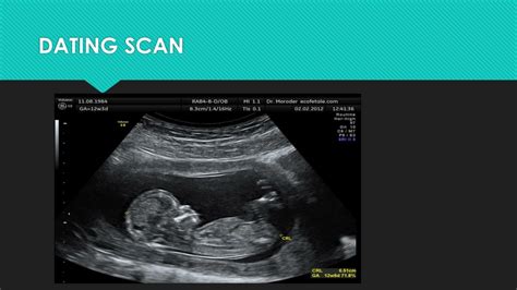 when is a dating scan done