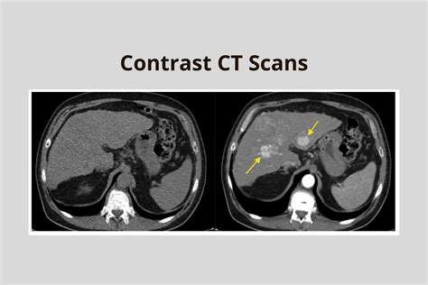 when is contrast used in ct
