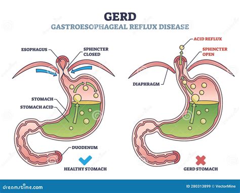when is gerd serious