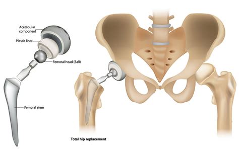 when is hip replacement indicated
