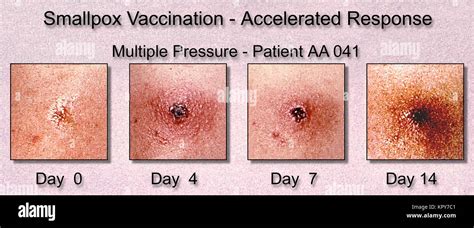 when is smallpox vaccine given