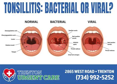 when is tonsillitis not contagious anymore