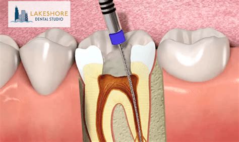 when should i get a root canal