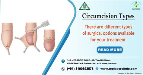 when should i get circumcised