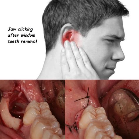 when should wisdom teeth be pulled