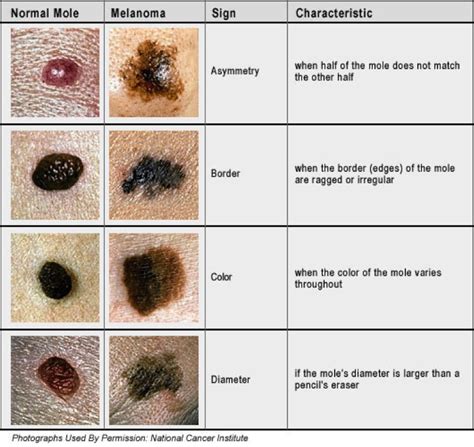 when should you get a mole checked