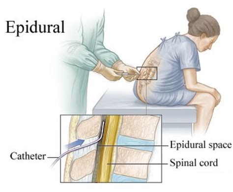 when should you get an epidural