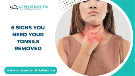 when should you get your tonsils removed