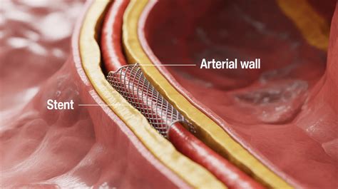 when stent is required in heart