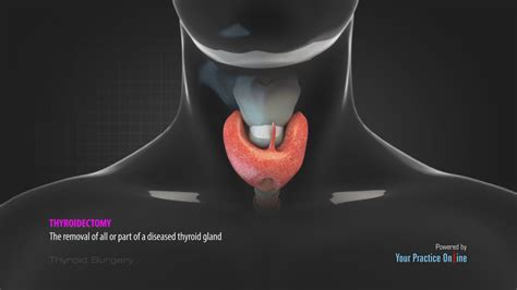 when thyroid surgery is necessary