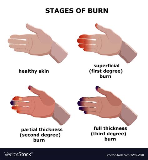 which is worse 1st or 3rd degree burns
