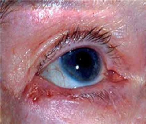 Which Key Feature Indicates Malignancy In A Client With Aids