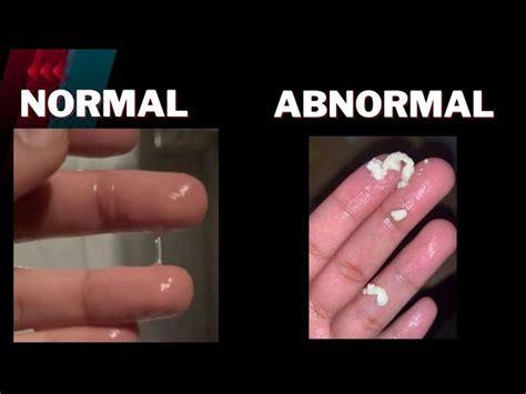 White Clumpy Discharge After Using Metronidazole Gel