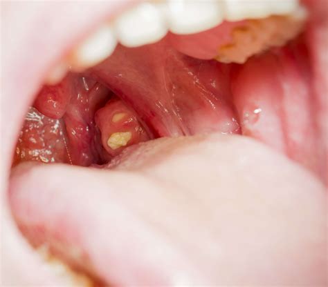 White Pustules Throat Sore Throat Pocket Food Tonsil Our Meetings Are Being Ruined By Dogs And A Toddler - Our Meetings Are Being Ruined By Dogs And A Toddler
