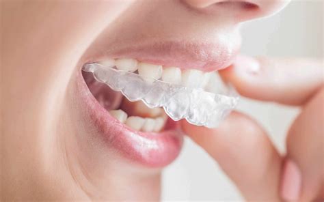 who can get invisalign braces for men