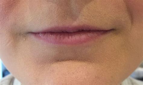 why do i have really thin lips treatment