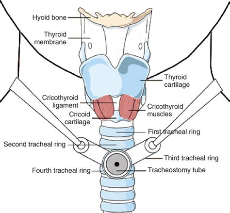Why Does A Tracheotomy Cause Pneumothorax