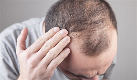 why does baldness affect mostly males