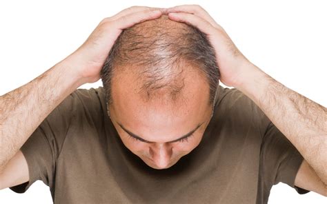 why does baldness affect mostly males
