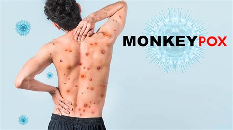 why is monkeypox more common in gay community