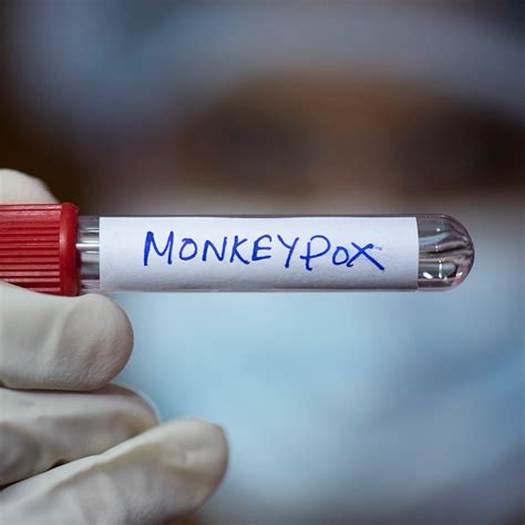 why is monkeypox spreading in gay population