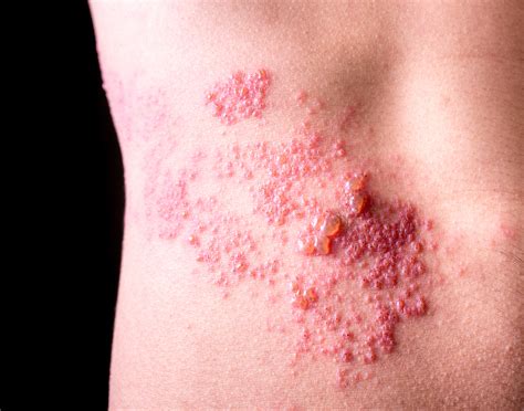Why Is Shingles Not Covered With Harvard Pilgrim