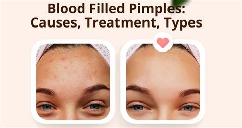 why is there blood in pimples