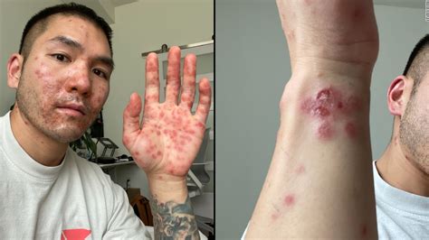 why monkey pox affects gay men