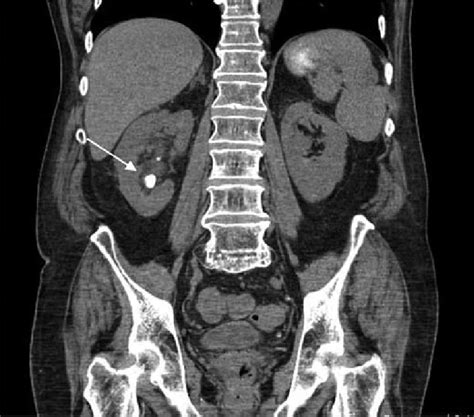 With Or Without Contrast Kidney Stone Ct