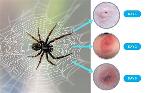 Wolf Spider Bite