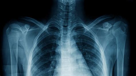 X For X Ray