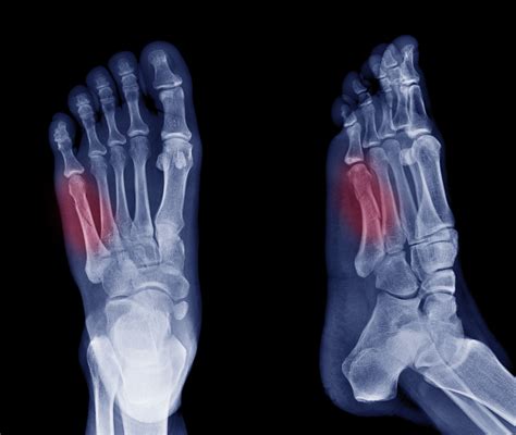 X Ray Broken Foot