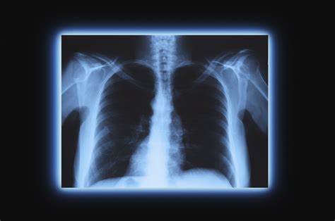 X Ray Definition Properties History And Applications Science Rays Science - Rays Science