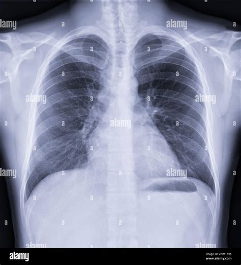 X Ray Of A Normal Chest