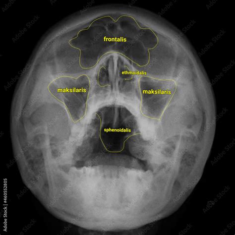 X Ray Sinus Waters View